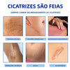 Scar Removal Cream | Removedor de Cicatrizes
