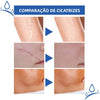 Scar Removal Cream | Removedor de Cicatrizes