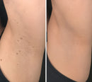 ✨ShapeOil® Adesivo 2 em 1 com Microagulhas e Hidrocoloide🍀 | Remove Verrugas Salientes, Acne, Verrugas Planas e Marcas de Pele | Ajuda a Melhorar Rugas, Cicatrizes e Imperfeições | Adesivos Invisíveis para Rosto e Corpo
