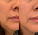 ✨ShapeOil® Adesivo 2 em 1 com Microagulhas e Hidrocoloide🍀 | Remove Verrugas Salientes, Acne, Verrugas Planas e Marcas de Pele | Ajuda a Melhorar Rugas, Cicatrizes e Imperfeições | Adesivos Invisíveis para Rosto e Corpo