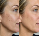 ✨ShapeOil® Adesivo 2 em 1 com Microagulhas e Hidrocoloide🍀 | Remove Verrugas Salientes, Acne, Verrugas Planas e Marcas de Pele | Ajuda a Melhorar Rugas, Cicatrizes e Imperfeições | Adesivos Invisíveis para Rosto e Corpo
